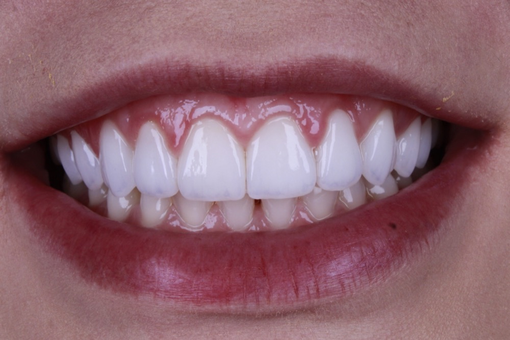 Sorriso depois das facetas