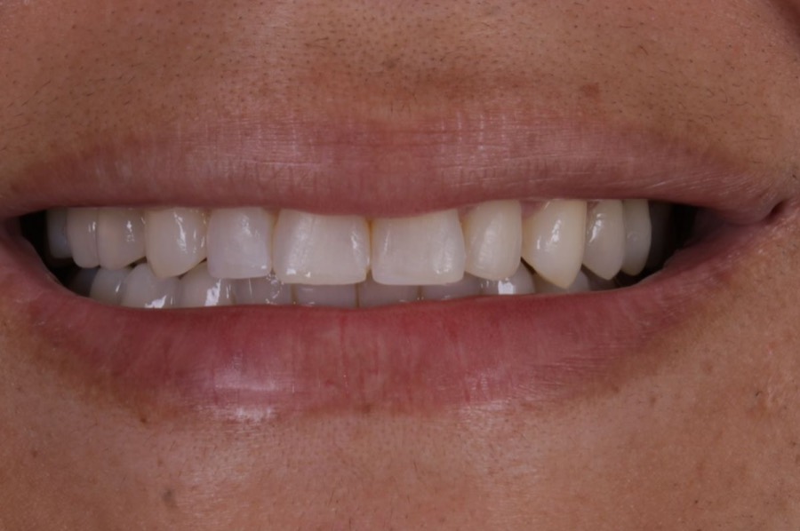 Sorriso antes das facetas