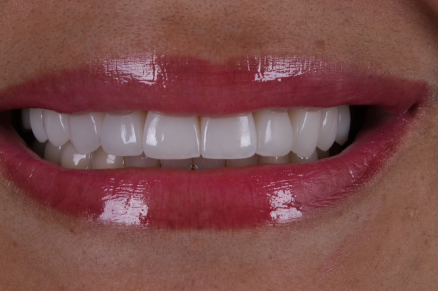 Sorriso depois das facetas