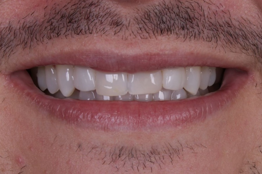 Sorriso antes das facetas
