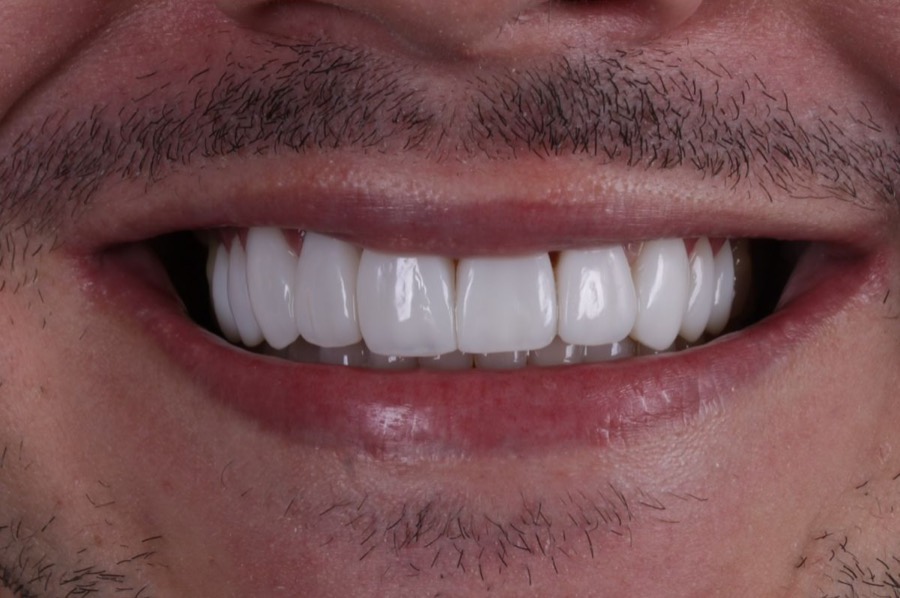 Sorriso depois das facetas