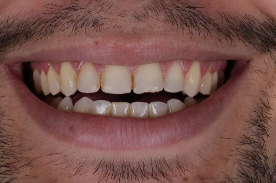 Sorriso antes das facetas