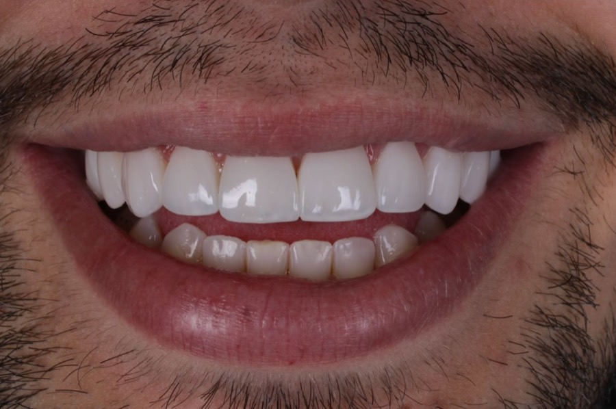 Sorriso depois das facetas