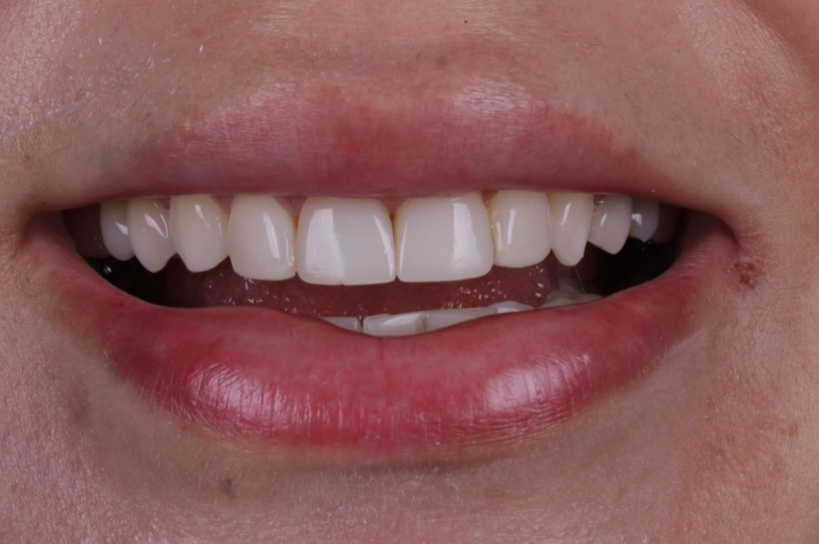 Sorriso antes das facetas