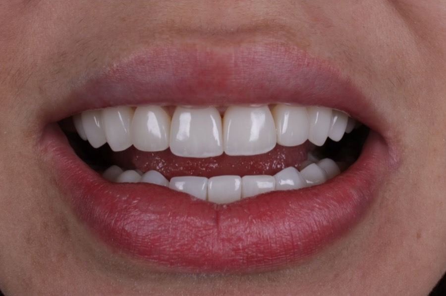 Sorriso depois das facetas