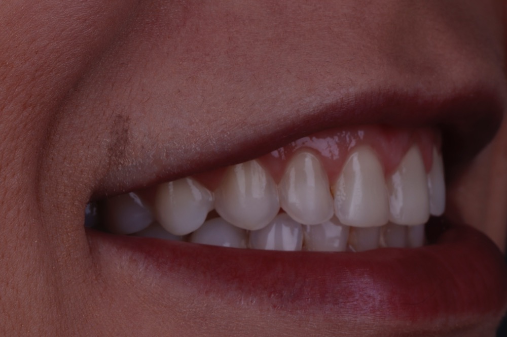 Sorriso antes das facetas