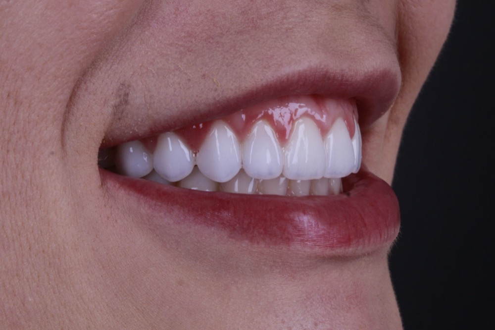Sorriso depois das facetas