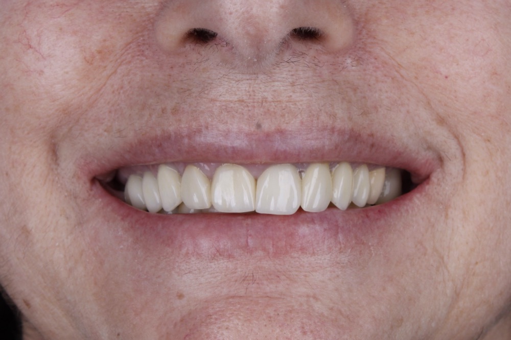 Sorriso depois das facetas