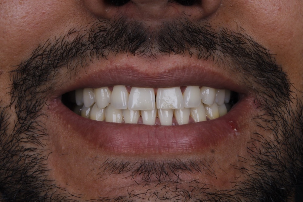 Sorriso antes das facetas