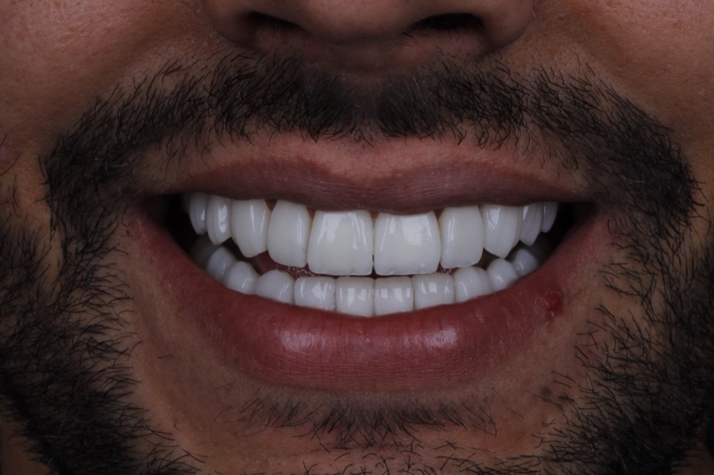 Sorriso depois das facetas