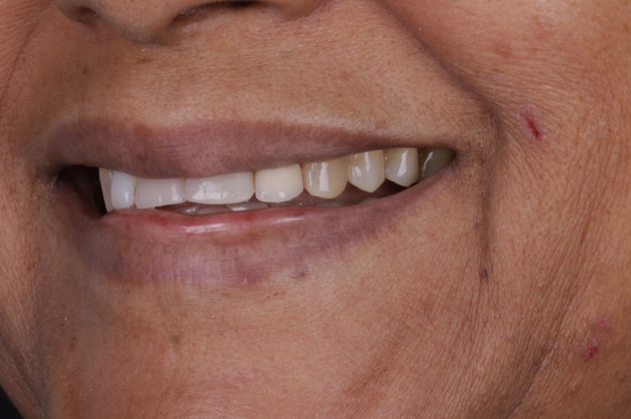 Sorriso antes das facetas