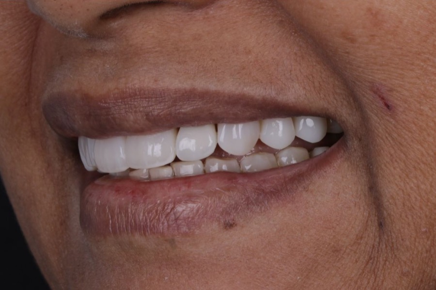 Sorriso depois das facetas