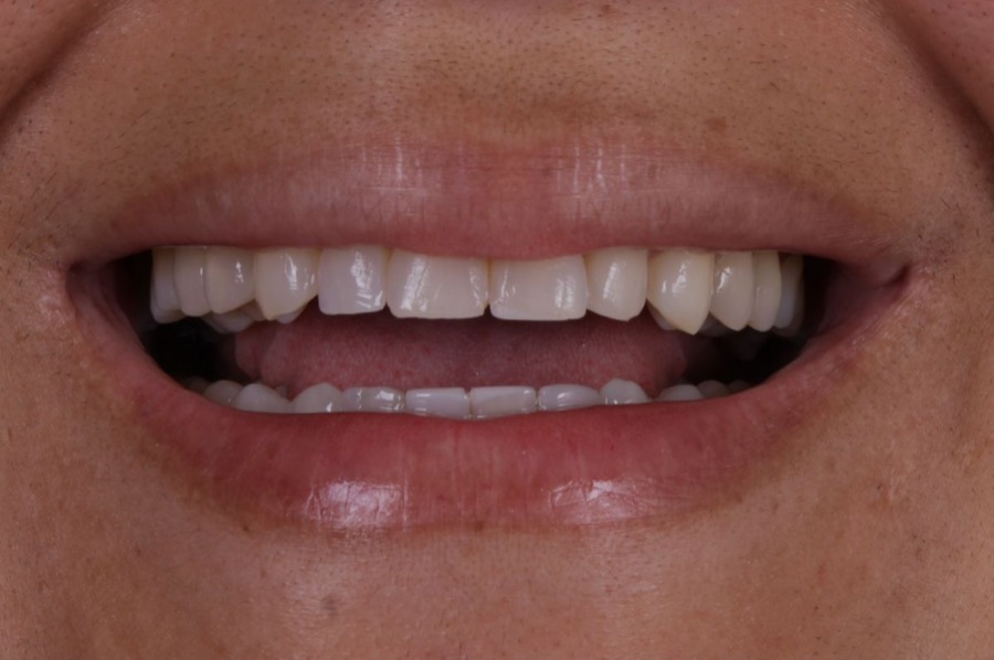 Sorriso antes das facetas