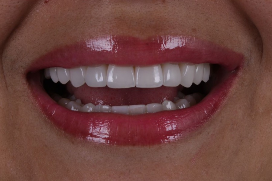 Sorriso depois das facetas