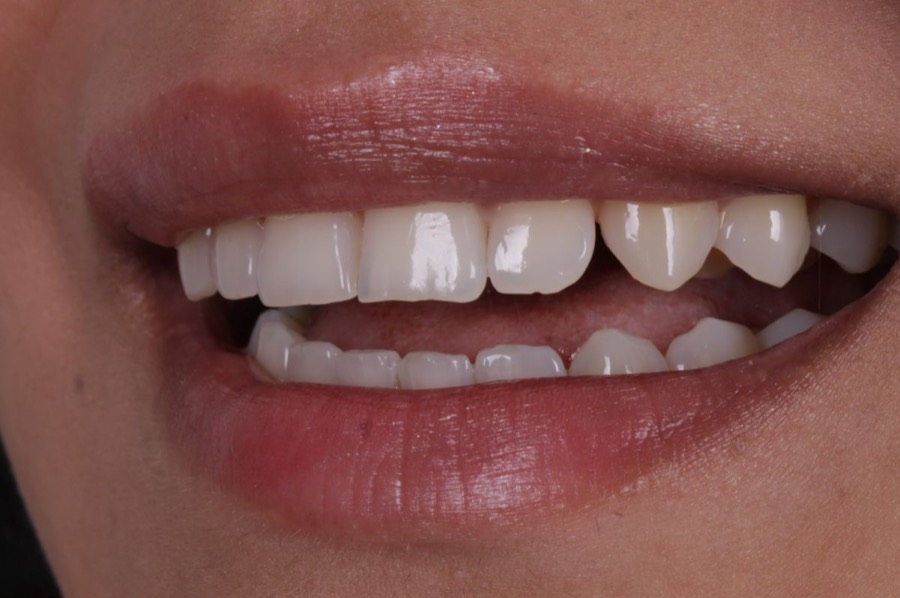Sorriso antes das facetas