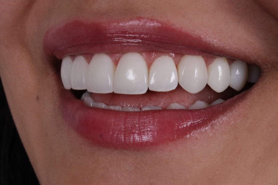 Sorriso depois das facetas