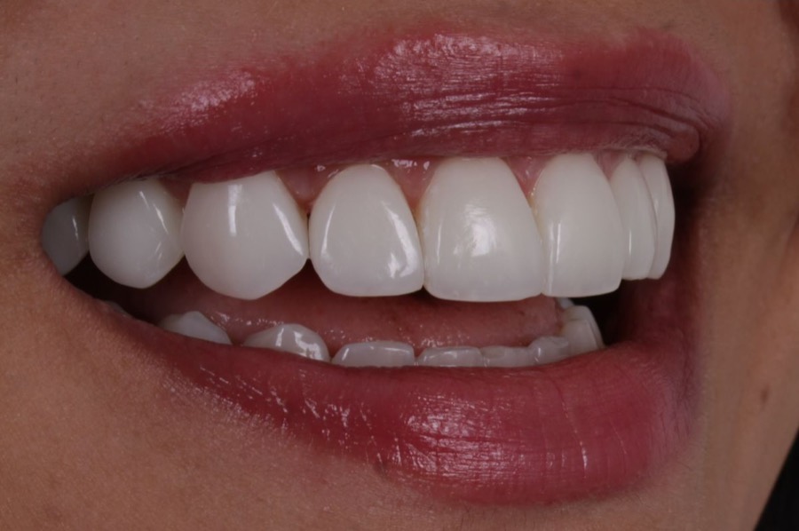 Sorriso depois das facetas