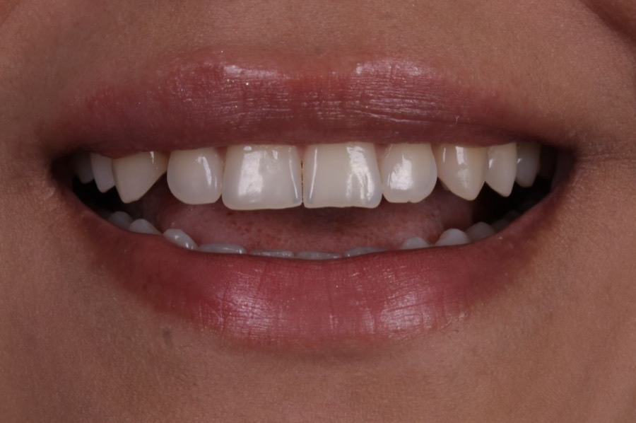 Sorriso antes das facetas