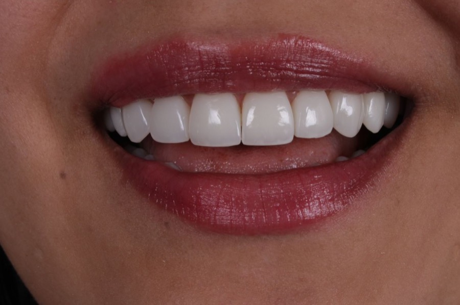 Sorriso depois das facetas